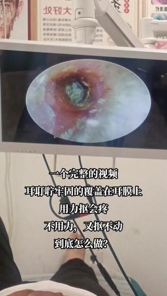 蓝牙耳机被耳屎堵住了缩略图