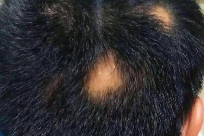 斑秃是艾滋病初期症状吗图标