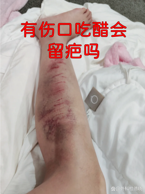 吃醋落疤图标