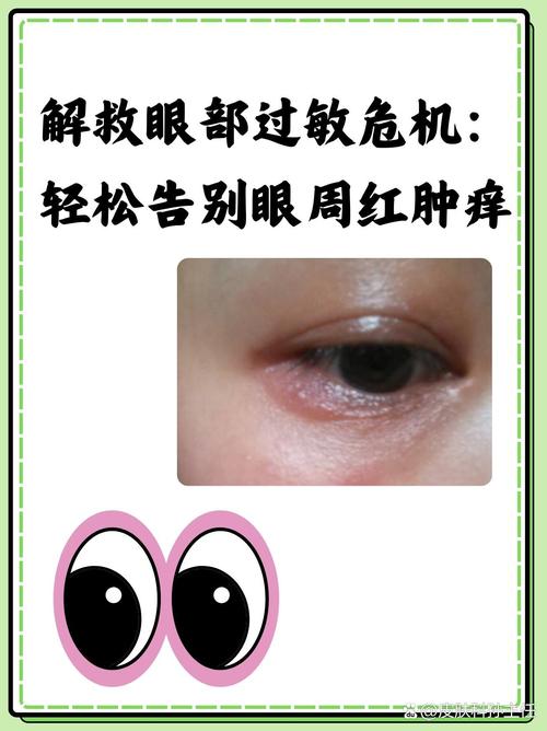 眼睛一圈红肿,痒,发红怎么办游戏截图