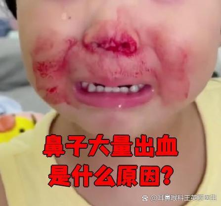 一支鼻子流鼻血图标