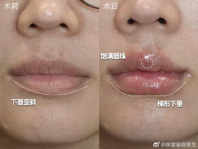 玻尿酸一针700能打吗图标