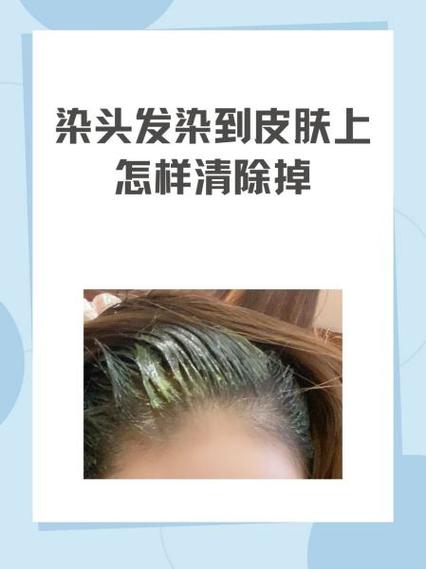 衣服上的染发剂怎么清除干净图标