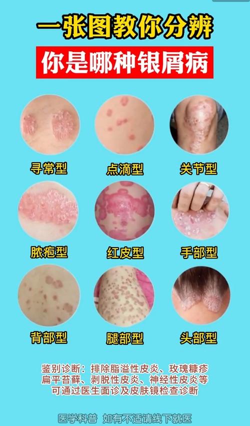 皮肤病图片对照缩略图