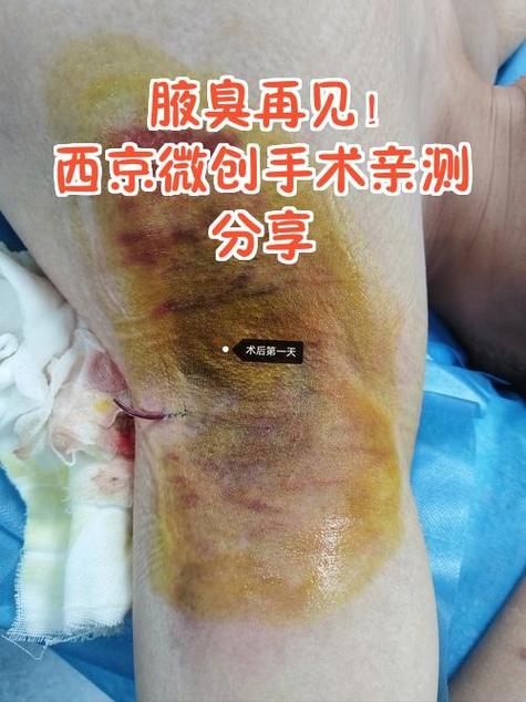 腋臭手术一般多少钱正规医院缩略图