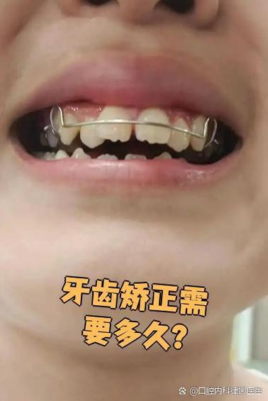 儿童牙齿上下咬合对齐怎么矫正图标