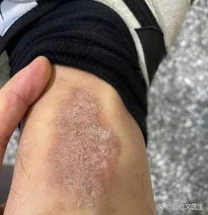 行李箱脱皮了怎么处理