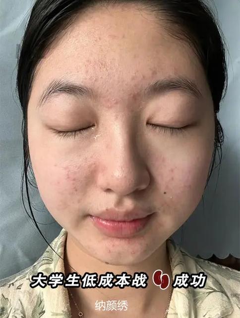 孩子青春痘严重怎么办游戏截图