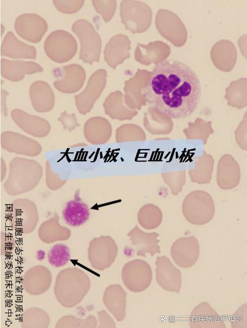 血小板是什么病图标
