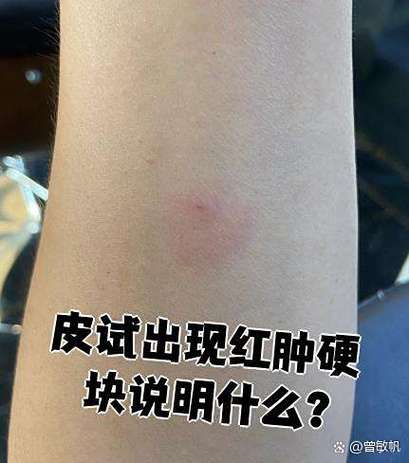 每次挂水都要做皮试吗