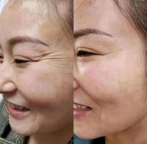 去脸部皱纹缩略图