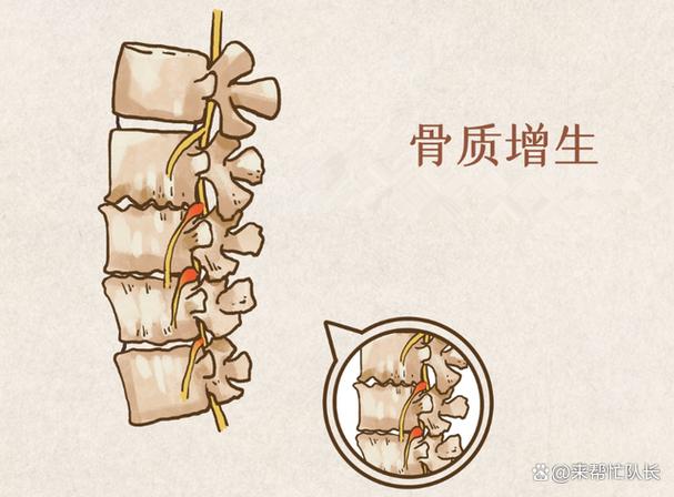 骨骼异常增生综合症