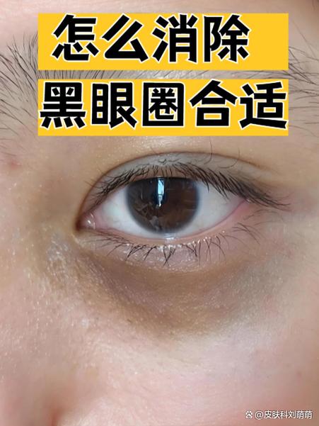 眼圈黑怎么解决