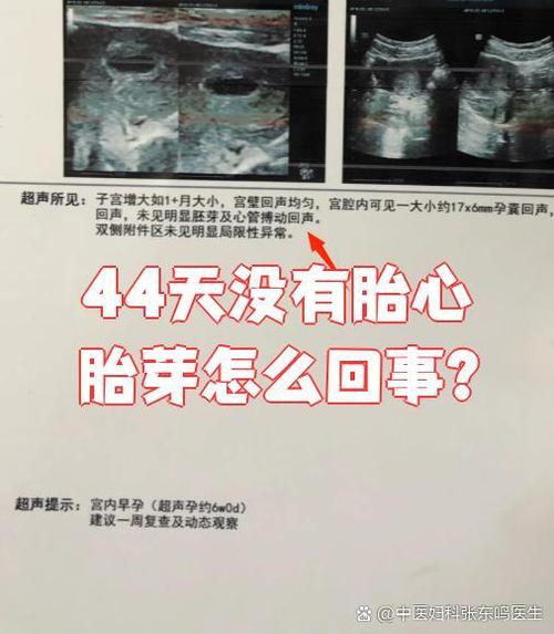 没胎心的主要原因