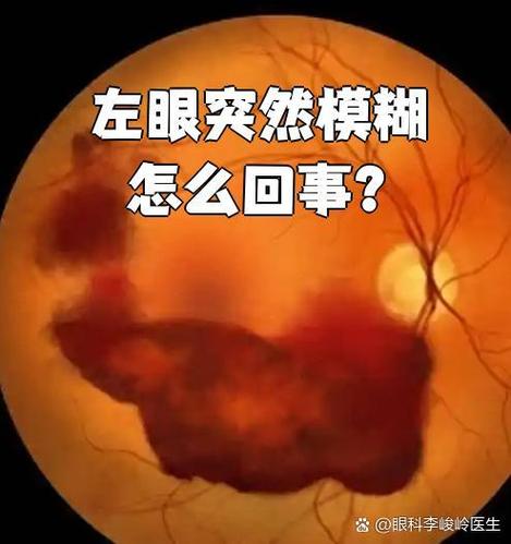 看东西眼睛模糊什么原因缩略图