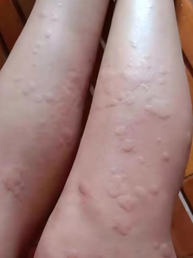 免疫力低引起的荨麻疹怎么治
