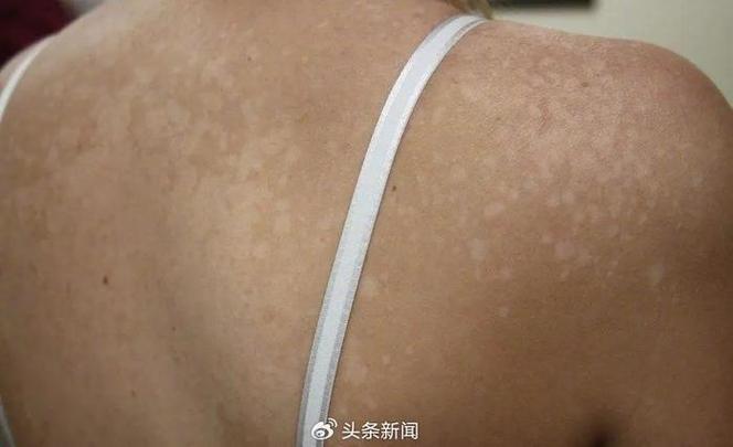 手脚白斑是什么原因引起的缩略图