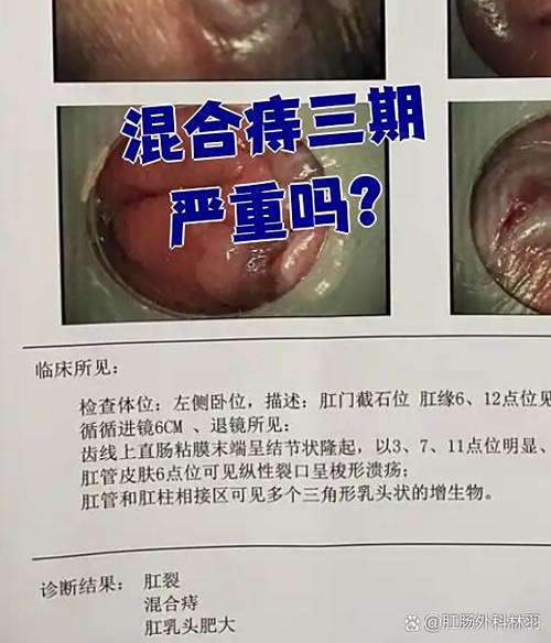 痔疮外痔肉球怎么消除缩略图