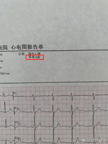 异常心电图需要治疗吗
