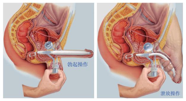 割完勃起变短了