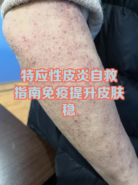 特应性皮炎图片及症状缩略图