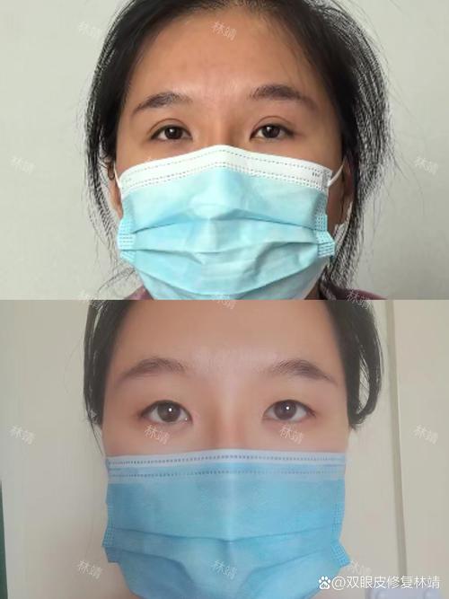 睡一觉起来变成单眼皮图标