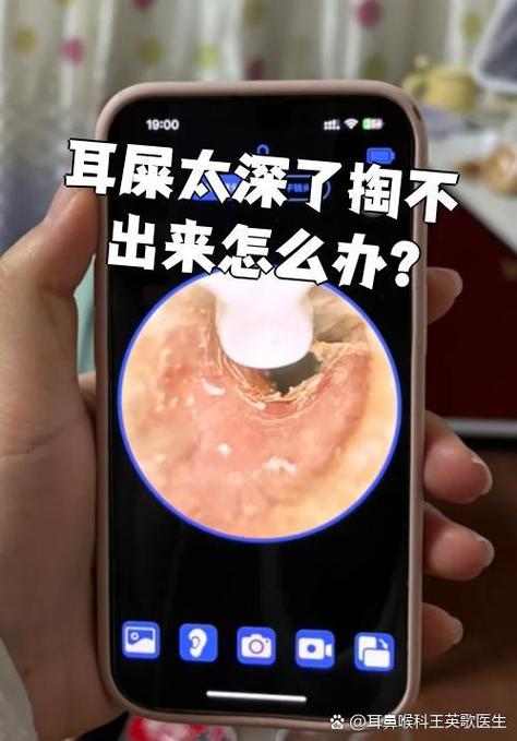 蓝牙耳机滤网被耳屎堵了缩略图