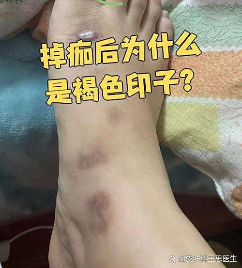 结痂后深褐色多久消失图标