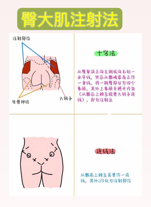 打屁股针怎么打 图解图标