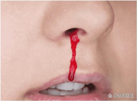高血糖流鼻血怎么回事缩略图