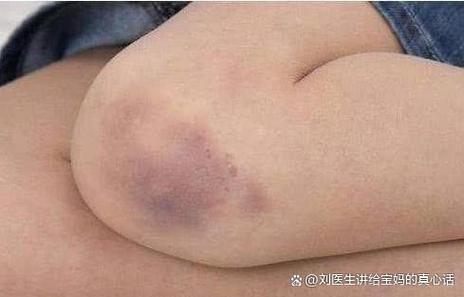 软组织挫伤图片