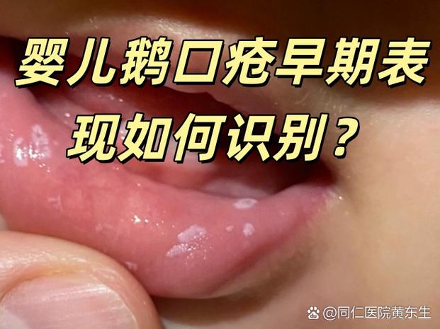 鹅口疮图片及症状缩略图
