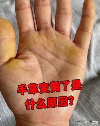 手掌突然黄了一块洗不掉