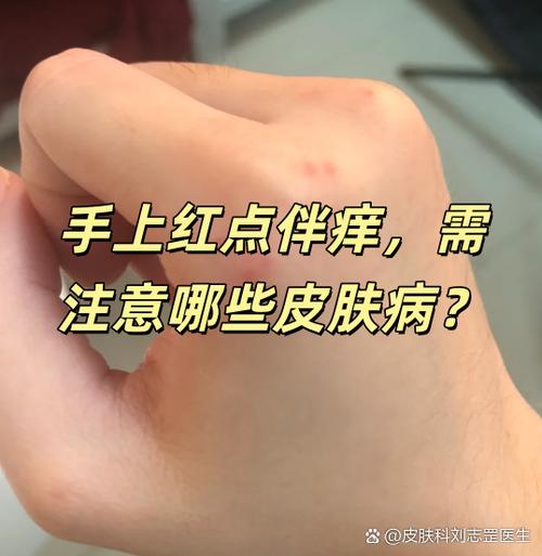 皮肤长红点像血痣不痛不痒