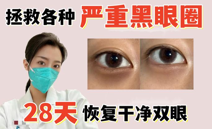 黑眼圈是怎么形成的,如何治疗