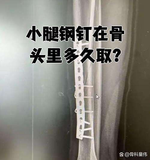 腿上钢钉多久可以取出