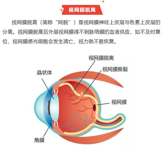 视网络脱落症状图标