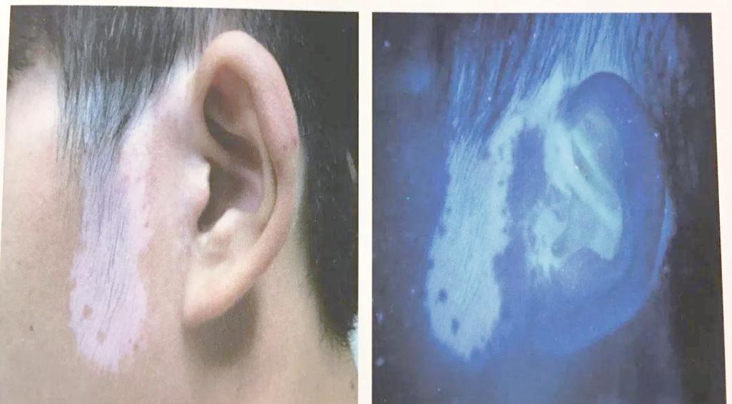 伍德灯下面皮肤正常颜色