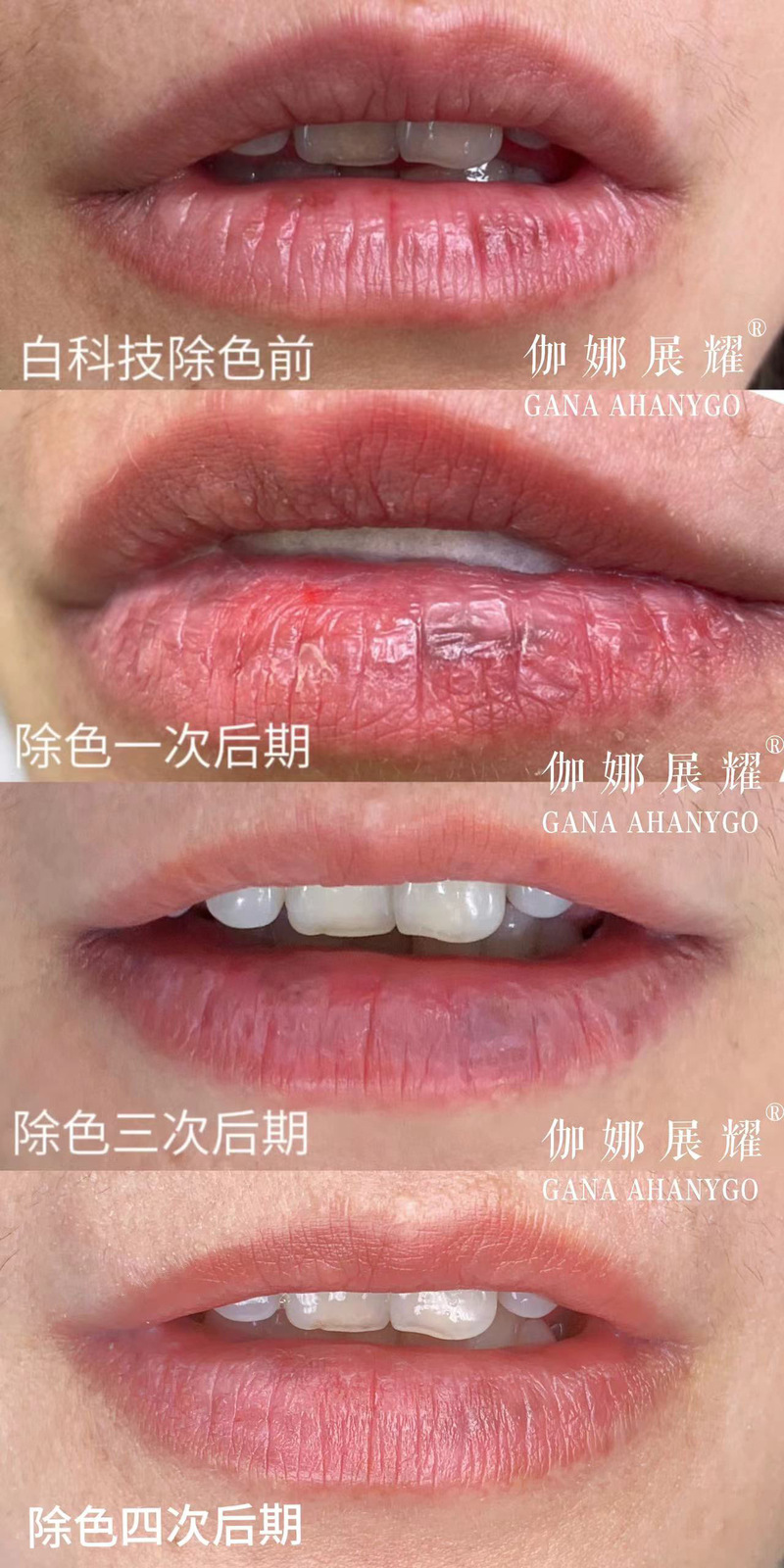嘴唇边缘痕迹怎么去除