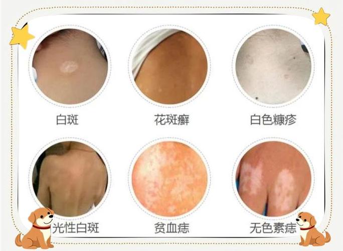 怎么判断白癜风和白斑图标