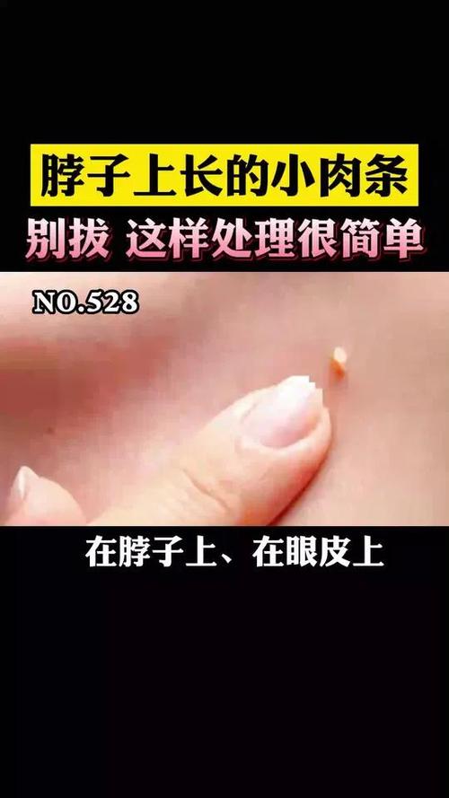 身上长小肉丁有危害吗
