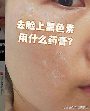 去黑色素沉淀最有效的药膏