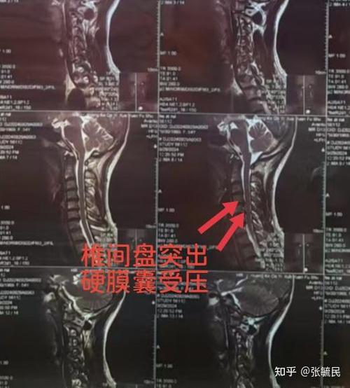 硬膜囊受压可以恢复吗