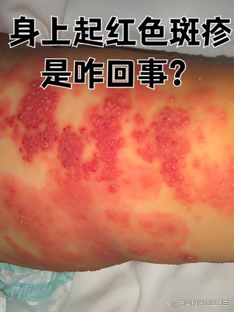 怎么判断自己过敏了