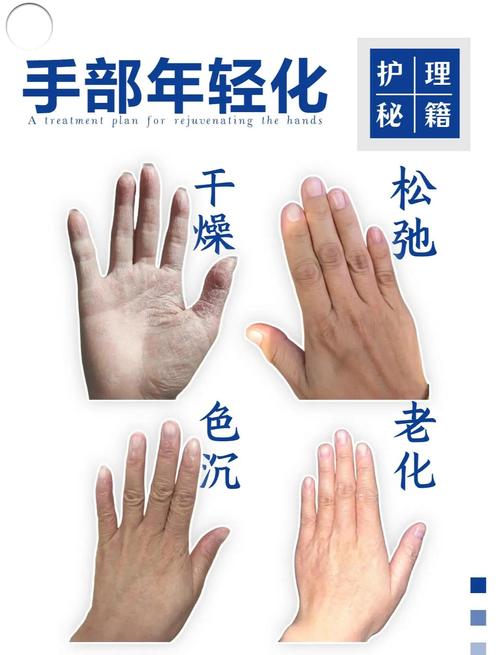 手皮干燥开裂什么原因缩略图