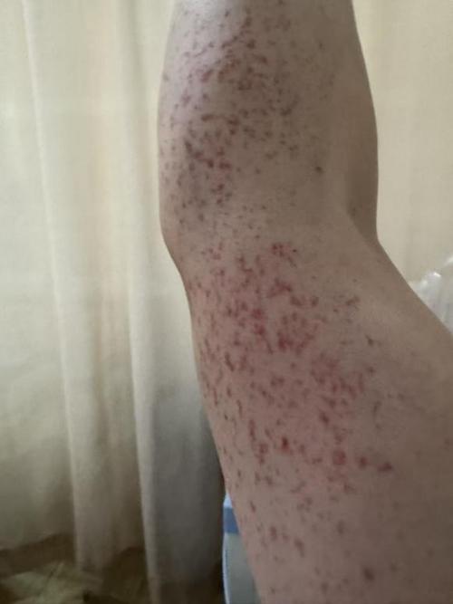 身上有凸起的小红点