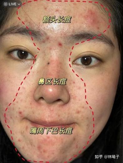 女生长痘怎么哄她开心游戏截图