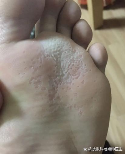 脚皮肤痒是什么原因引起的缩略图
