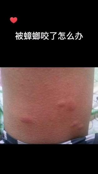 蟑螂咬了是什么样子图缩略图