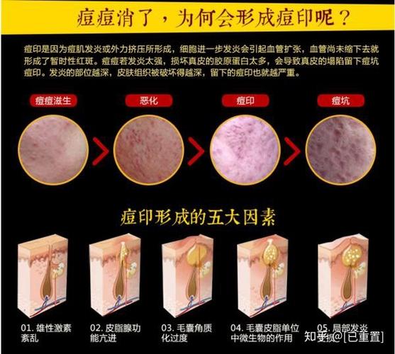 怎么去痘印